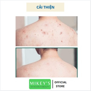 Xà phòng ngừa mụn lưng CARECELLA, giảm mụn lưng, làm sạch sâu giúp da luôn mịn màng