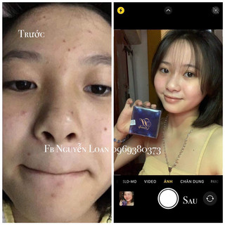 KEM MỤN X2 THBEAUTY (combo 2 kem)