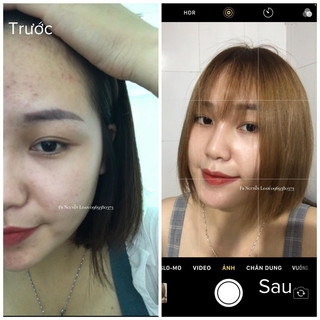 KEM MỤN X2 THBEAUTY (combo 2 kem)