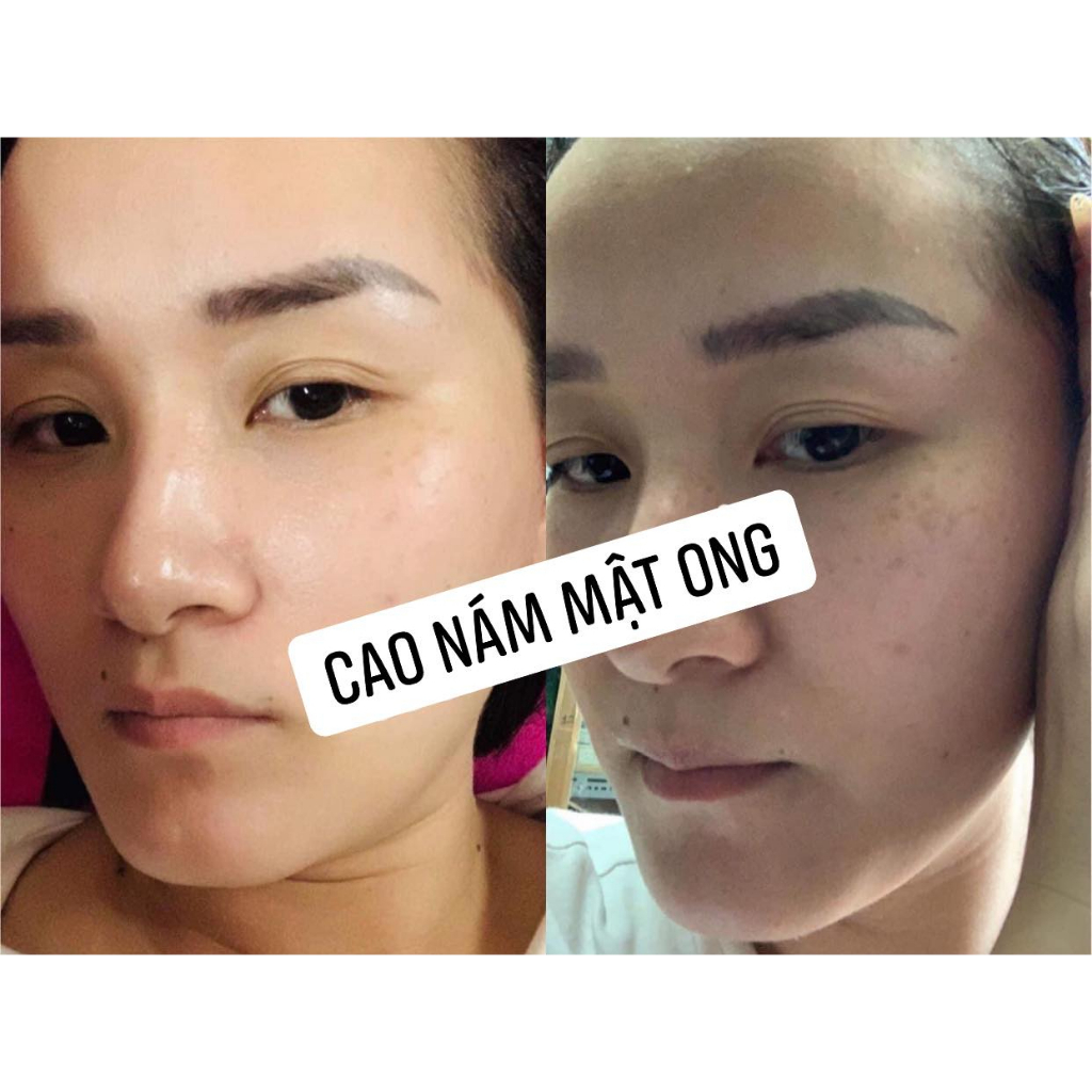 Cao Nám Mật Ong Melasma Pro Mộc Tuyết chính hãng