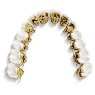 Mắc cài mặt lưỡi