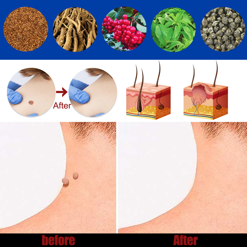 Kem Rụng Mụn Thịt Dư SOUTH MOON - Kem Thảo Dược Giảm Mụn Thịt Dư, Nốt Ve Chó, U Mềm Treo, Nốt Ruồi SOUTH MOON