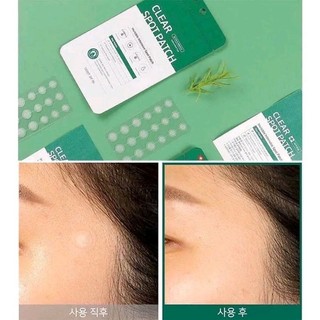 Miếng dán mụn Somebymi giảm sưng viêm