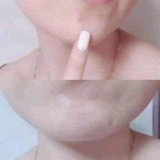 Miếng dán mụn Somebymi giảm sưng viêm