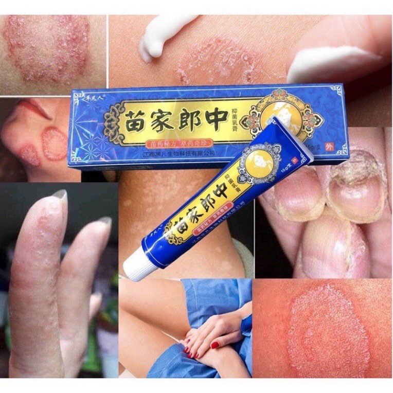 Kem xanh trị nấm tuýt 15g