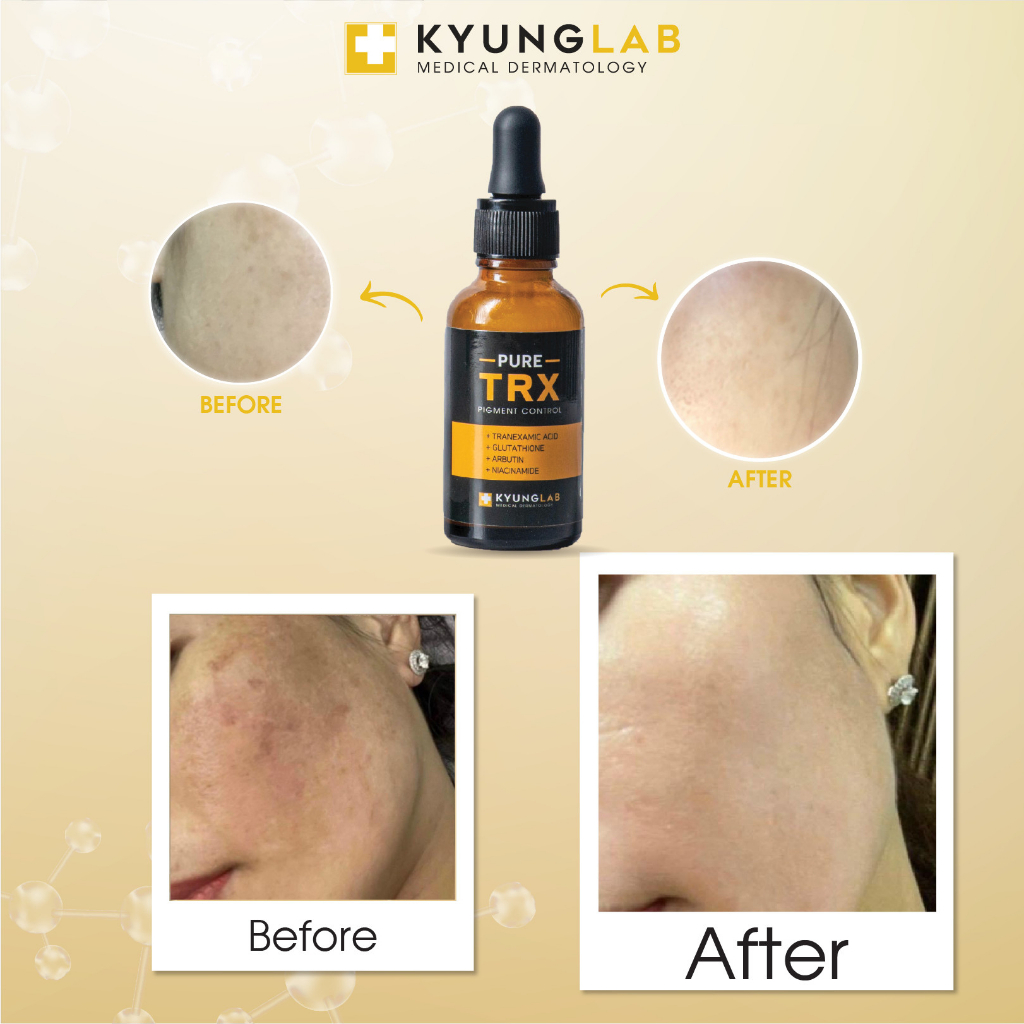 Serum nám KyungLab Pure TRX mờ nám tàn nhang dưỡng trắng da 30ml