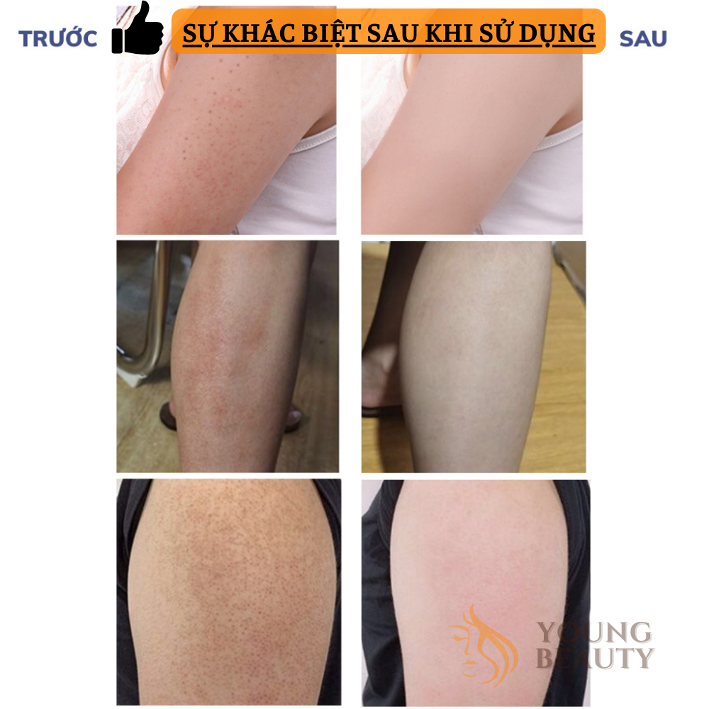 Kem dưỡng viêm nang lông NICOR - Kem đánh bay dày sừng nang lông, dưỡng ẩm, dưỡng trắng da - YOUNG BEAUTY