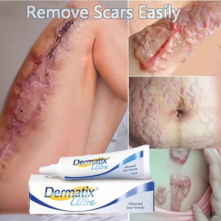 Kem sẹo Dermatix Ultra Kem làm mờ rạn da, kem tái tạo da hiệu quả cho bà bầu Anti-stretch Marks Cream - mờ sẹo, gi