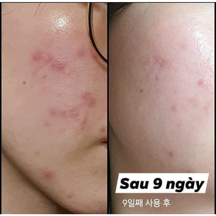 Kem dưỡng ẩm, phục hồi, làm dịu da Dr.G R.E.D Blemish Clear Soothing Cream