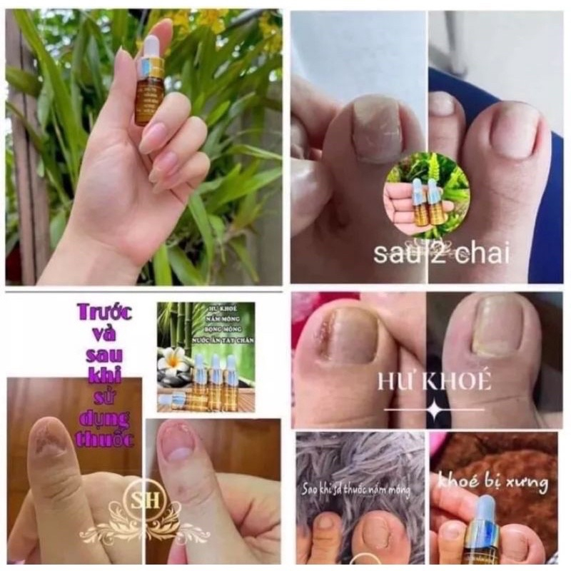 Combo Sỉ 50 Serum Nấm Móng Đánh Bay Bọng Móng Hư Khóe Nấm Móng Nước Ăn Tay Chân