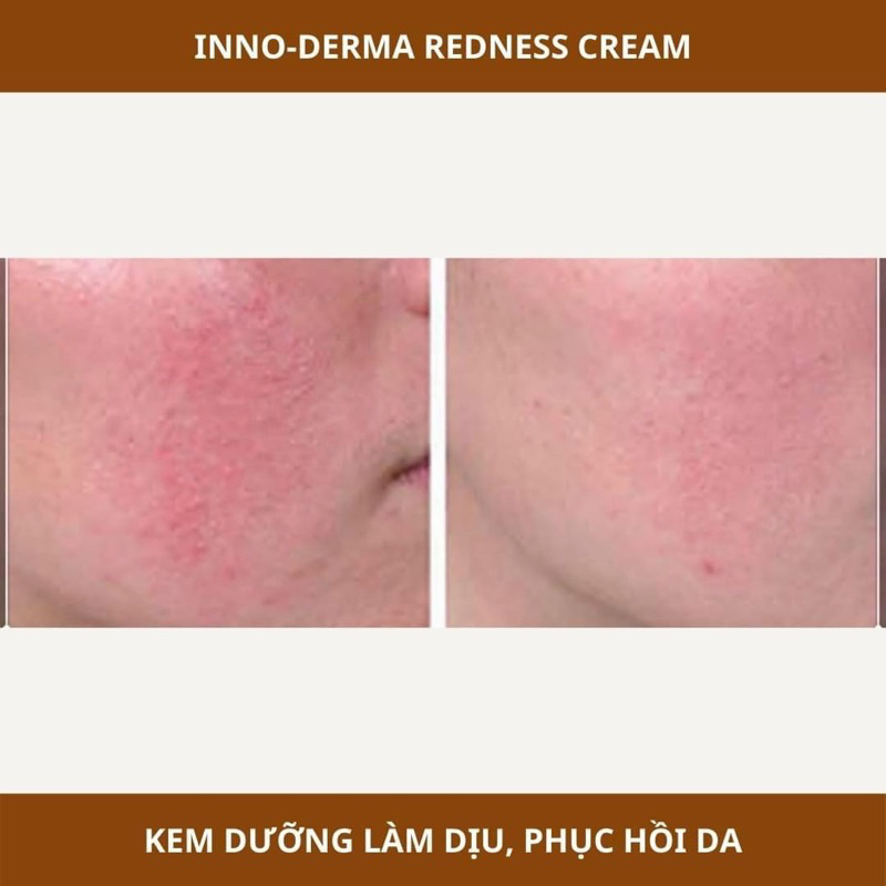 Kem Làm Dịu Tái Tạo Da Mẩn Đỏ Giãn Mao Mạch Do Corticoid Innoaesthetics Inno-Derma REDNESS CREAM 50ml