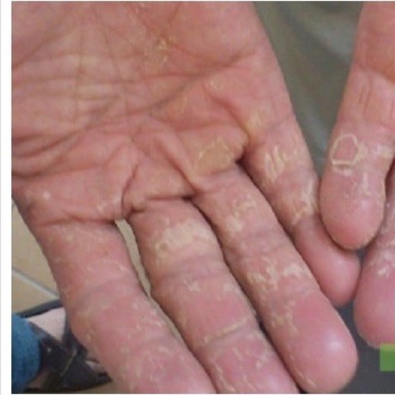 Kem Chuyên Nấm, Nứt Nẻ... Đa Năng