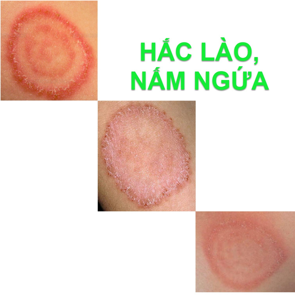 Thảo dược Hết Hẳn Nấm ngứa, Nấm hình tròn, Nấm đồng xu, Hắc lào Háng, Bụng, Đùi, Mông (Đông Y Cổ Truyền)_Sẵn có