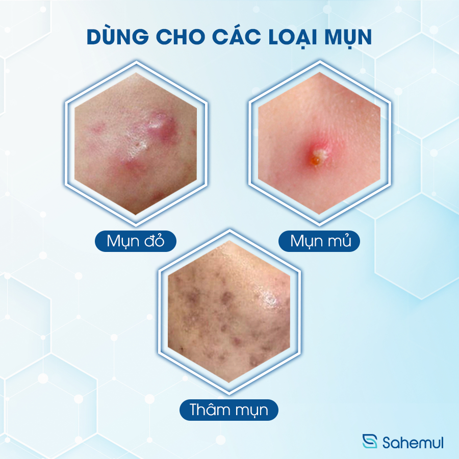 Combo 2 Tuýp Kem Ngừa Mụn Sahemul Dùng Cho Mụn Viêm, Mụn Bọc, Mụn Mủ, Mụn Trứng Cá Và Thâm Mụn 20gr