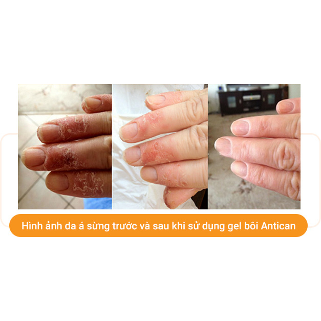 Gel Bôi VIETLIFE ANTICAN GEL 50gr Dưỡng ẩm da và giúp trắng sáng, thúc đẩy tái tạo tế bào mới