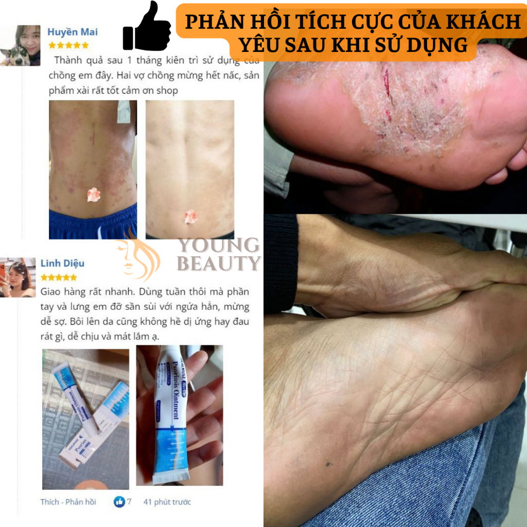 Kem bôi viêm da sừng HERBAL - Kem hỗ trợ da bị vẩy nến, á sừng, mụn nước, bảo vệ da ngứa ngáy mẫn đỏ - YOUNG BEAUTY