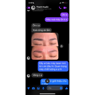 Máy xóa xăm laser mini SE