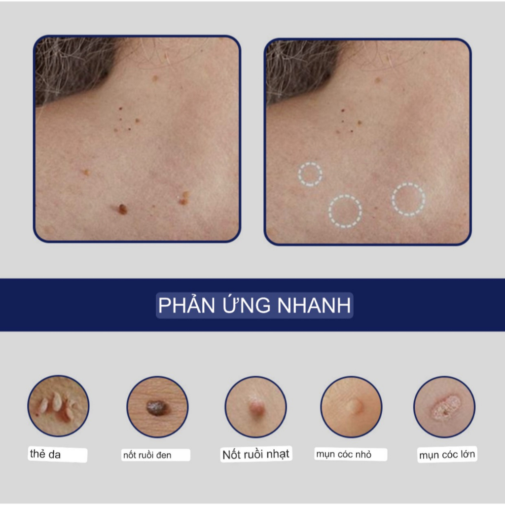 Gel tẩy mụn cóc, mụn thịt, nốt ruồi, tàng nhan...New Skin Tag Remover Wart Treatment