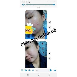 [ Kèm quà] Combo chuyên mụn Huỳnh Đỗ, sạch mụn hết thâm