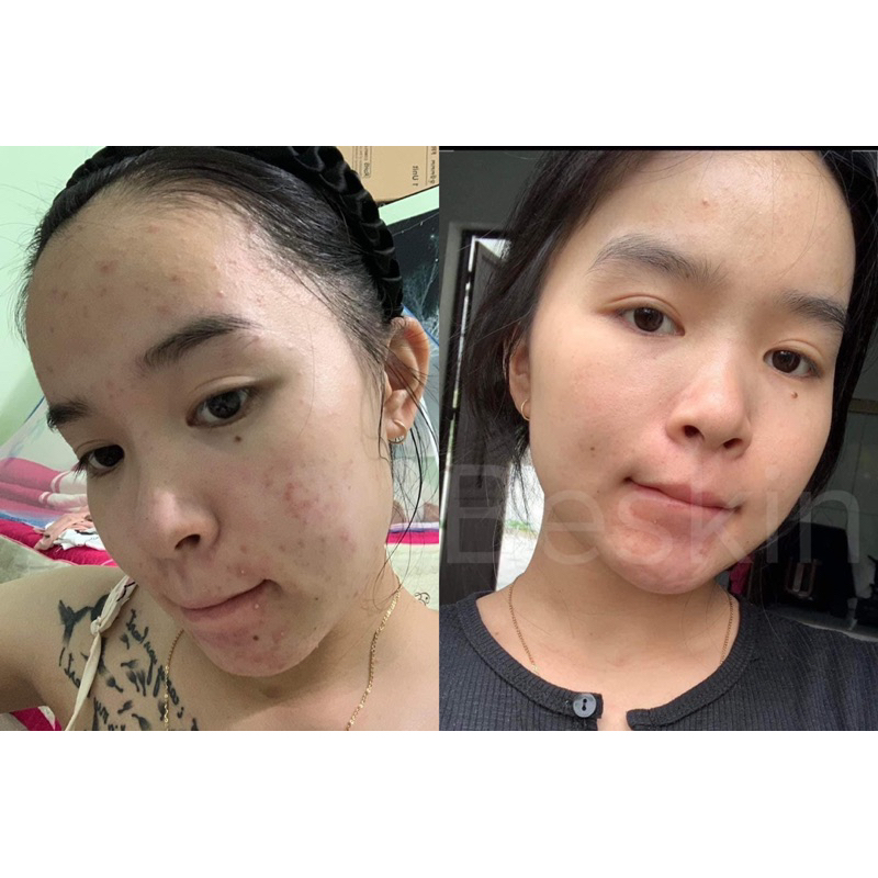 SERUM MỤN
