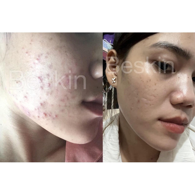 SERUM MỤN