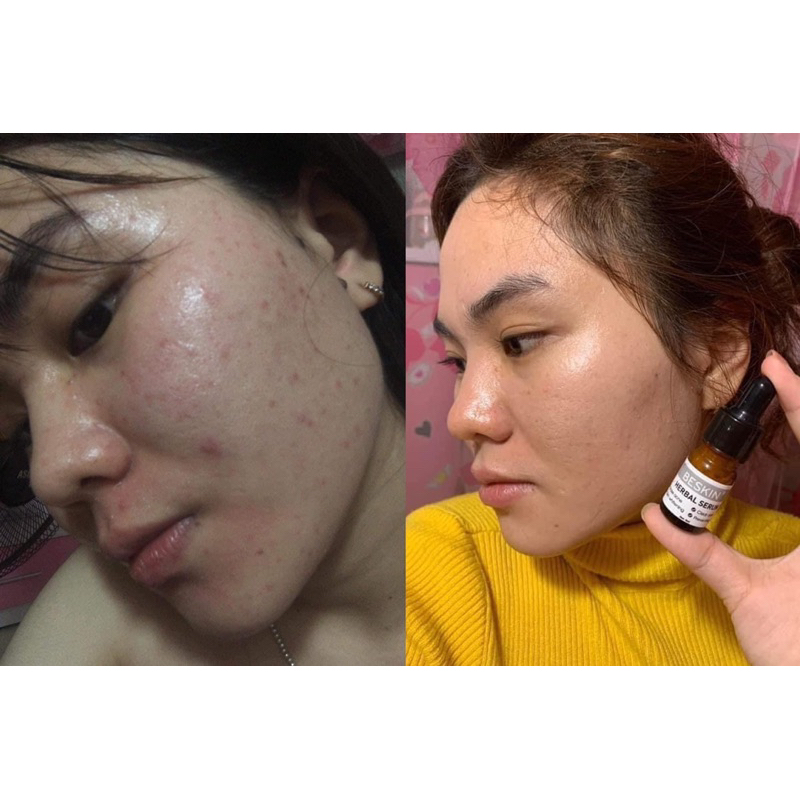 SERUM MỤN