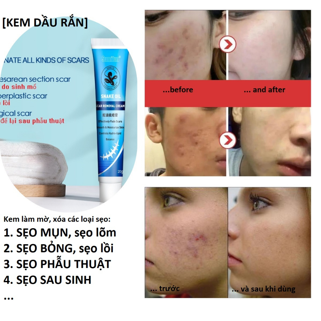 Kem xóa sẹo lồi, sẹo bỏng, sẹo mụn, sẹo sau sinh, thành phần thảo dược, đóng tuýp tiện dụng có thể tự bôi tại nhà