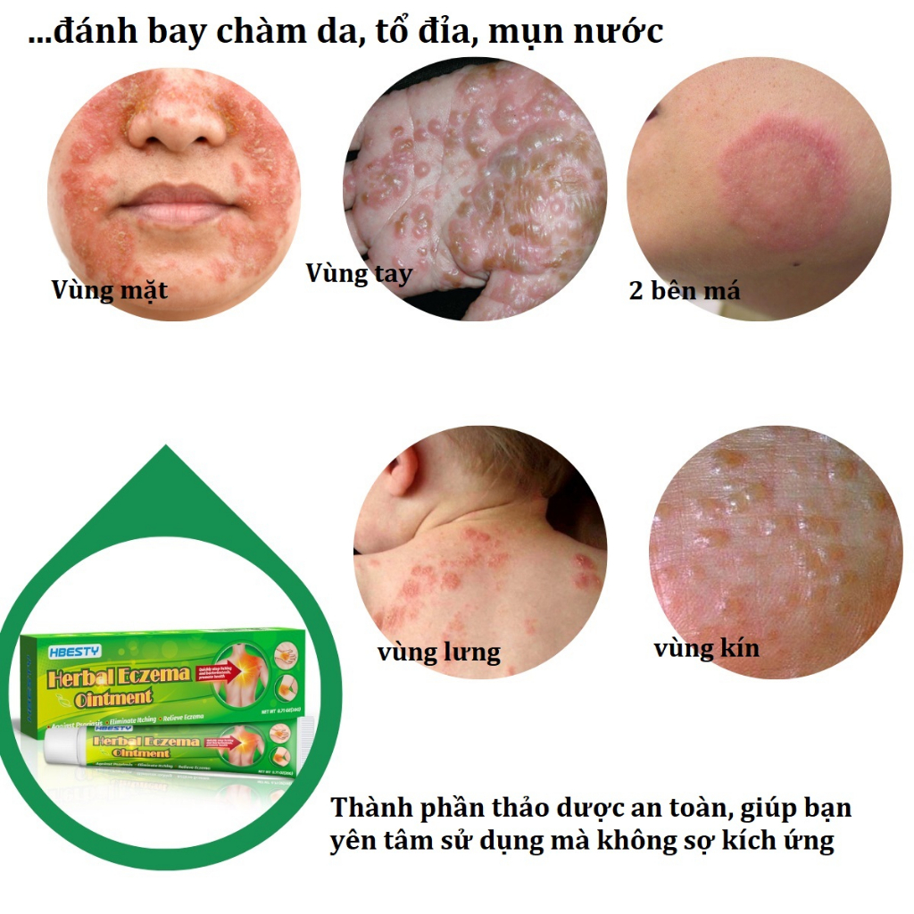 Kem da liễu bôi ngoài da eczema, chàm nước, chàm khô, tổ đỉa, mụn nước, thành phần thảo dược tự nhiên_HBESTY