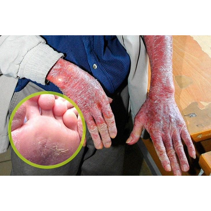 Kem Da Liễu, bôi Nấm Da Đầu, Vảy Nến, Á Sừng, Hắc Lào, Lang Ben, thành phần thảo dược tự nhiên, 100% Herbal