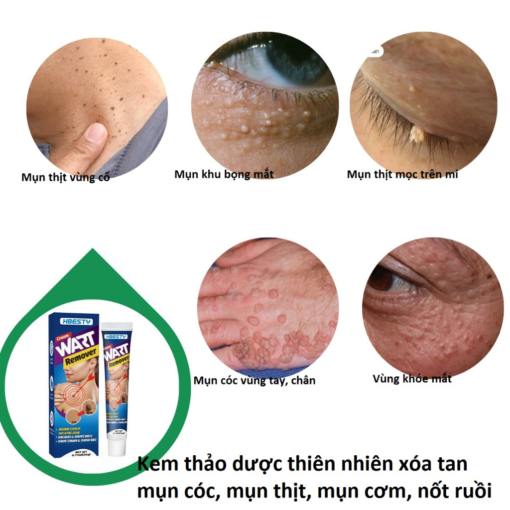 Kem bôi mụn thịt, mụn cóc, mụn cơm, ... thành phần thảo dược an toàn và tiện dụng_HBESTY Herbal
