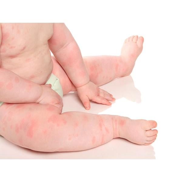Thảo dược quý Hết Sạch Chàm, Viêm Da, mẩn đỏ thô, ráp, rát ở Lưng, Tay, Chân Em Bé, Trẻ Em (Đông Y cổ truyền)_Cực lành
