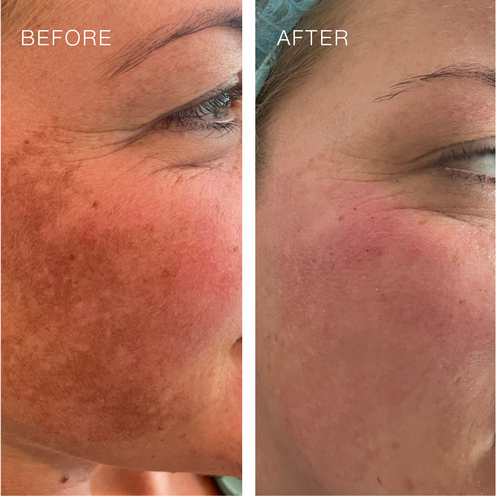 Decaar Algae Peeling Powder - Peel da từ vi tảo, thay da trẻ hóa khắc phục mọi khuyết điểm trên da