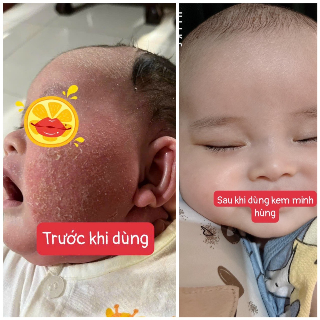 Kem Bôi Da Minh Hùng Chính Hãng - Dưỡng Ẩm Da Bé - Kem Bôi Chàm Sữa, Hăm Tả Mẩn Ngứa