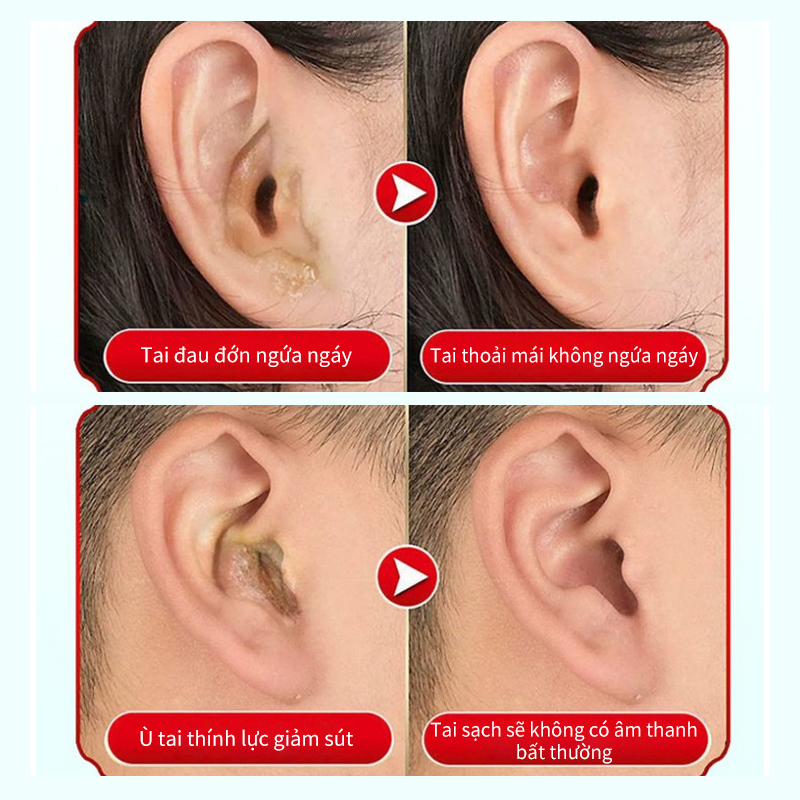 Dung dịch nhỏ tai Thuốc nhỏ tai viêm tai giữa trợ giảm ù tai điếc tai tan ráy tai cho bé và người lớn sưng tai 20ml