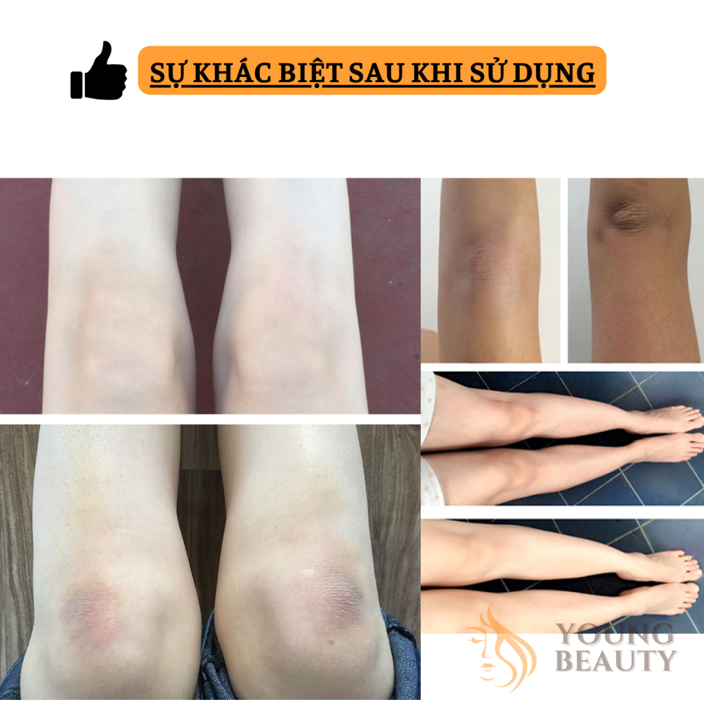 Kem xóa mờ thâm đa năng MOPOYAT - Kem mờ thâm body, nách, đầu gối, khuỷu tay, giúp da trắng sáng - YOUNG BEAUTY