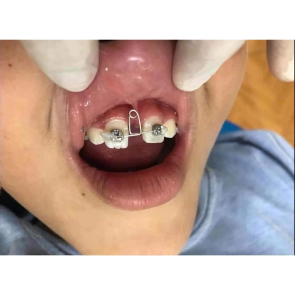 Loop đóng khoảng 2 răng cửa