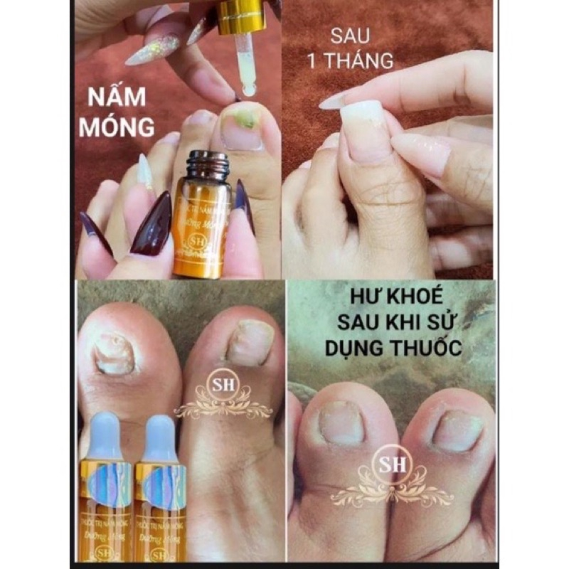 Combo 10 Serum Đánh Bay Nấm Móng, Hư Khoẻ Bọng Móng Nặng Nước Ăn Chân Gia Truyền
