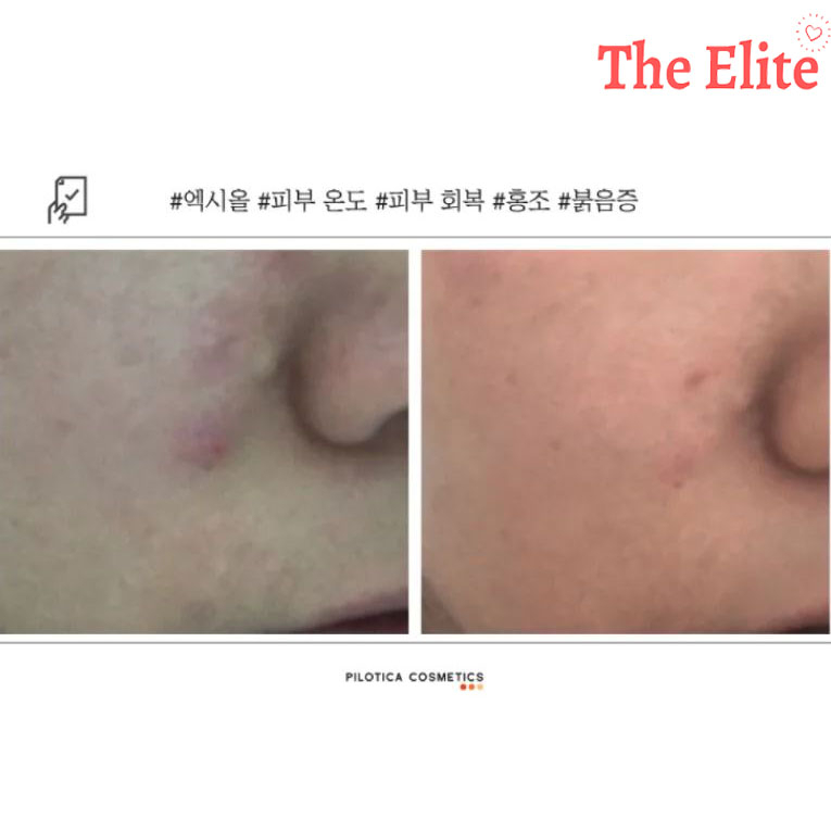 Serum Exsior căng bóng, dịu da, cấp ẩm phục hồi bảo vệ da siêu đỉnh