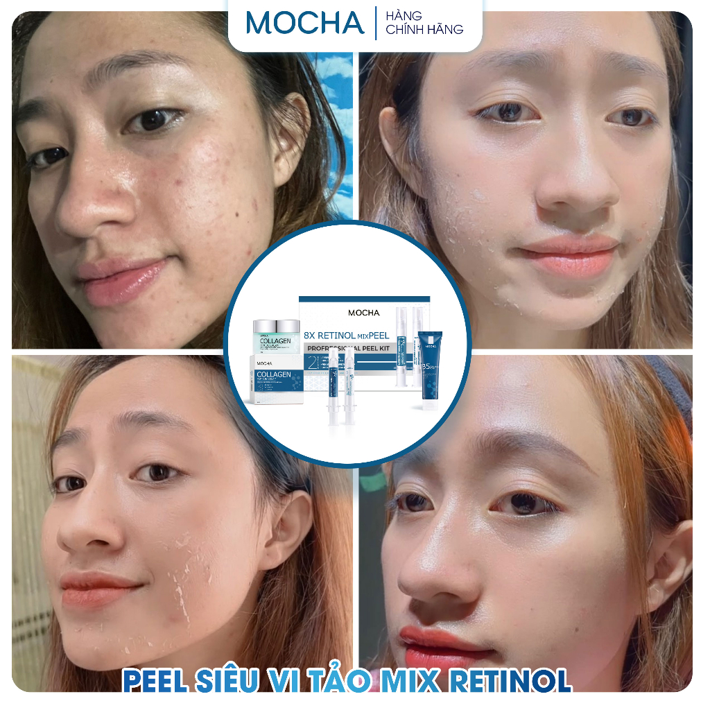 Peel Da Vi Tảo Retinol Mix Peel MOCHA, Tinh Chất Tái Tạo Da Sinh Học Tại Nhà 10ml x 2