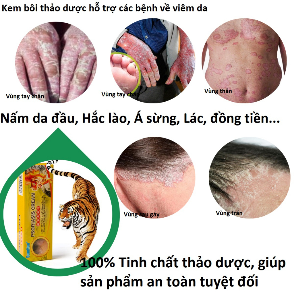 Kem thảo dược bôi da vảy nến, á sừng, lác đồng tiền, hắc lào, nấm da đầu, ... thành phần thảo dược 100%
