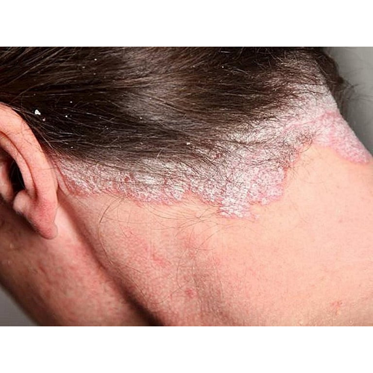 Kem Bôi Nấm Da Đầu, Nấm Da, Vảy Nến, Á Sừng, ... thành phần thảo dược 100%, Cam kết hiệu quả tức thì.