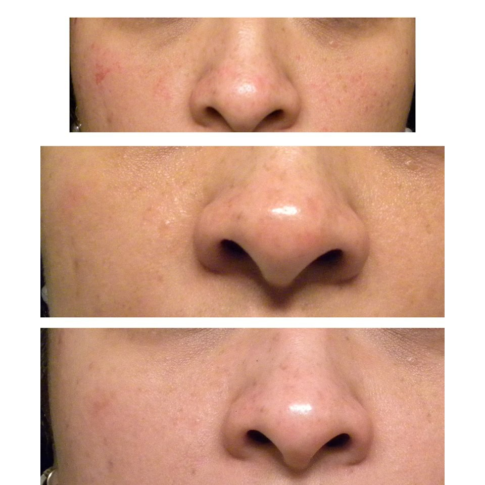 Serum The Ordinary Niacinamide 10% + Zinc 1% Giúp Cân Bằng Bã Nhờn Làm Sáng Da Thu Nhỏ Lỗ Chân Lông 30ml