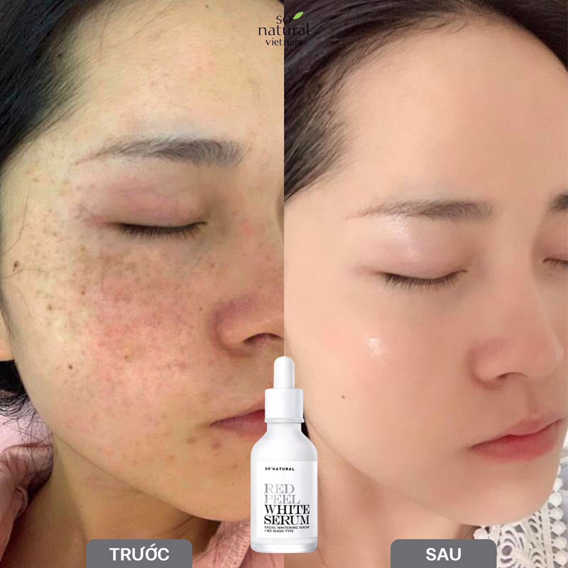 𝐒𝐄𝐑𝐔𝐌 RED 𝐏𝐄𝐄𝐋 WHITE SERUM 𝐓.𝐑𝐈̣ 𝐍𝐀́𝐌 𝐒𝐎'𝐍𝐀𝐓𝐔𝐑𝐀𝐋 - Ức Chế Nám, Dưỡng Sáng Từ Sâu Bên Trong