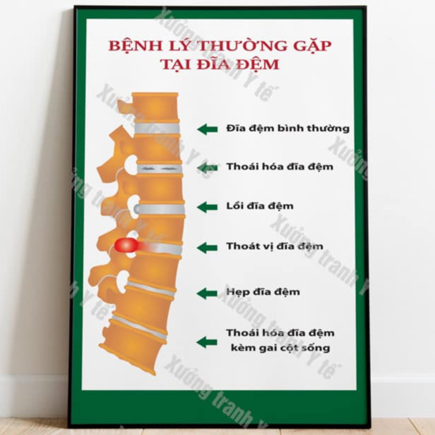 (Decal Dán) - Tranh Xương Khớp: Bệnh Lý Thường Gặp Tại Đĩa Đệm