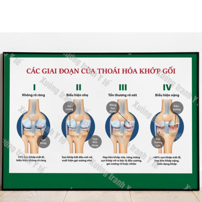 (Decal Dán) Tranh Xương Khớp: Các Giai Đoạn Của Thoái Hóa Khớp Gối