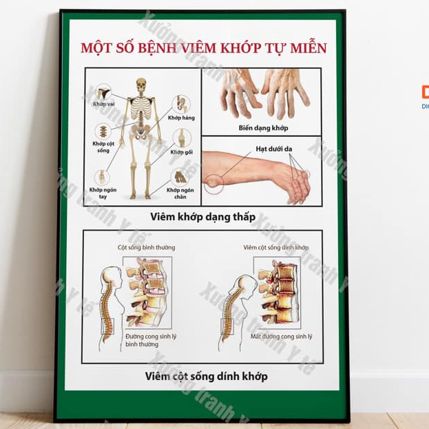(Decal Dán) Tranh Xương Khớp: Một Số Bệnh Viêm Khớp Tự Miễn