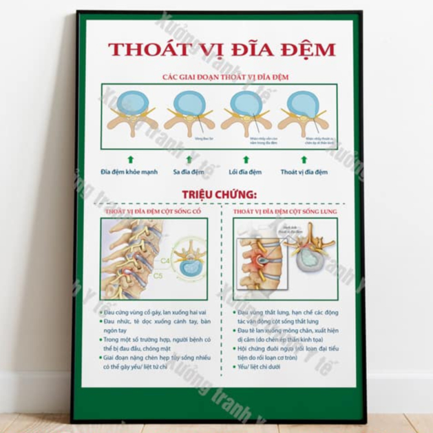 (Decal Dán) Tranh Xương Khớp: Thoát Vị Đĩa Đệm
