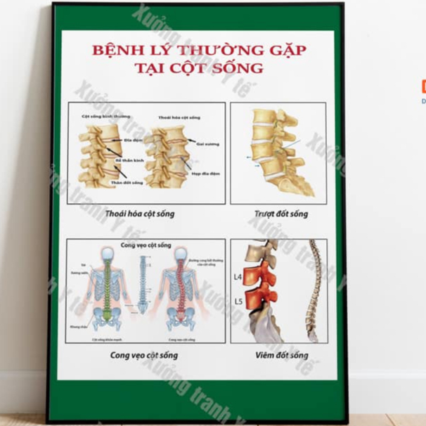 (Decal Dán) Tranh Cột Sống: Bệnh Lý Thường Gặp Tại Cột Sống