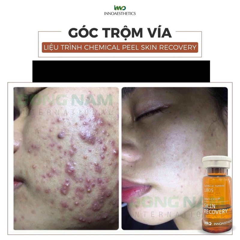 HOẠT CHẤT PEEL DA GIÚP GIẢM MỤN INNOAESTHETICS SKIN RECOVERY