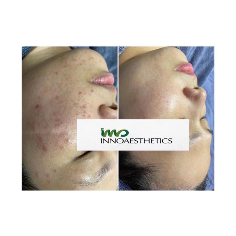 HOẠT CHẤT PEEL DA GIÚP GIẢM MỤN INNOAESTHETICS SKIN RECOVERY